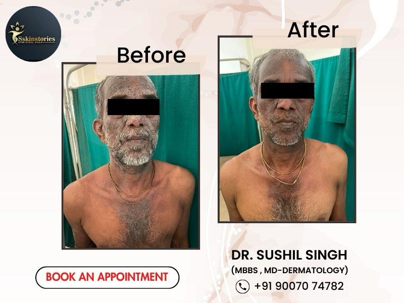 Before-after results of dermatology treatment on face.