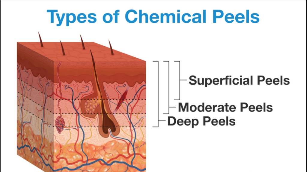 chemical peeling treatment in kolkata