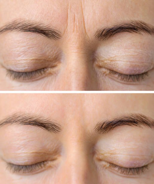 best botox treatment in kolkata